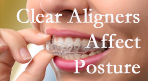 Clear aligners influence posture which Nashua chiropractic helps.