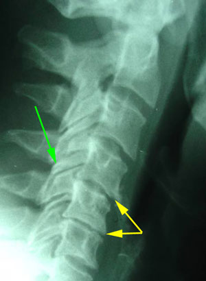 disc degeneration treated at Moriarty Chiropractic