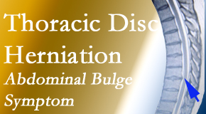 Moriarty Chiropractic cares for thoracic disc herniation that for some patients prompts abdominal pain.