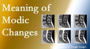 Moriarty Chiropractic sees many back pain and neck pain patients who bring their MRIs with them to the office. Modic changes are often seen.