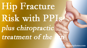 Moriarty Chiropractic shares new research describing higher risk of hip fracture with proton pump inhibitor use. 