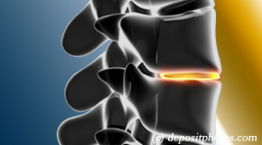Nashua degenerative spinal changes 