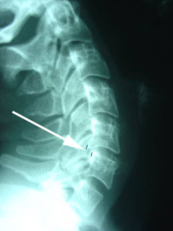 extension instability of cervical spine
