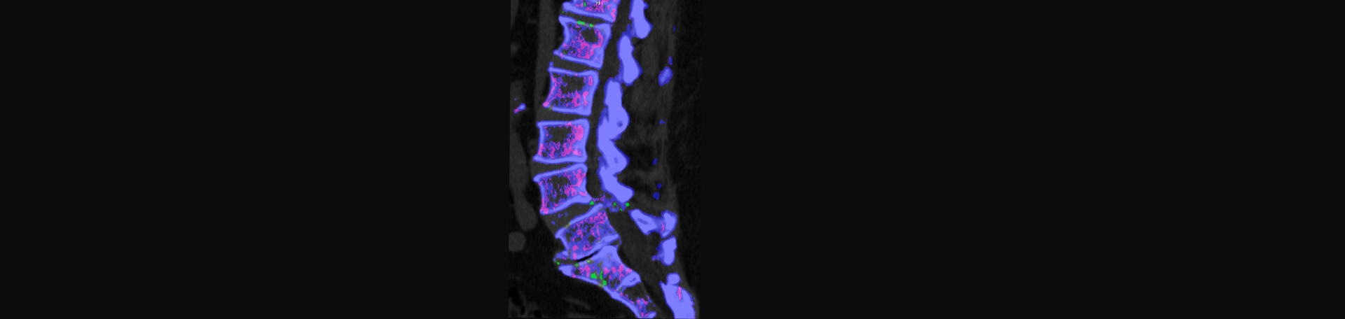 Moriarty Chiropractic is aware that inflammatory spinal gout is a differential diagnosis to consider for patients who present with back pain and other spine related symptoms.