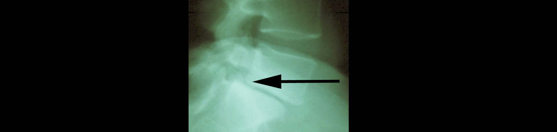 Nashua spondylolisthesis