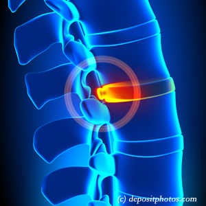 image of lumbar Nashua disc herniation