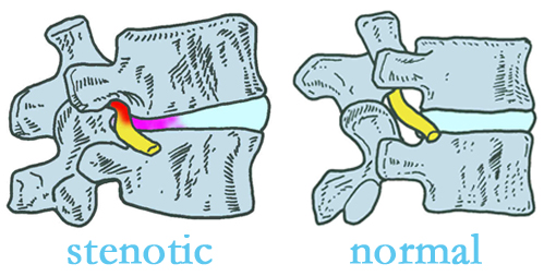 Nashua stenotic and normal spinal discs
