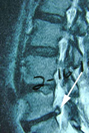 disc herniation that returned after surgery for its removal